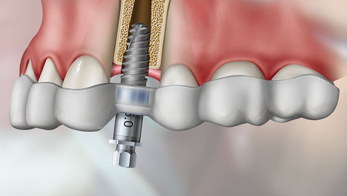 Cirurgia Guiada