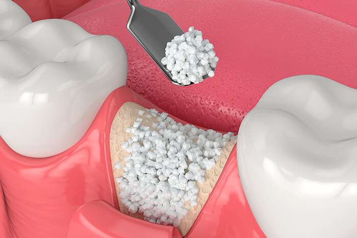 Biomateriais para enxerto ósseo – como funciona ?